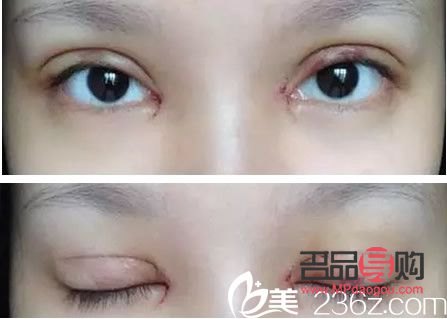 双眼皮7mm恢复后多宽图片男(双眼皮7mm恢复后多宽图片男生)