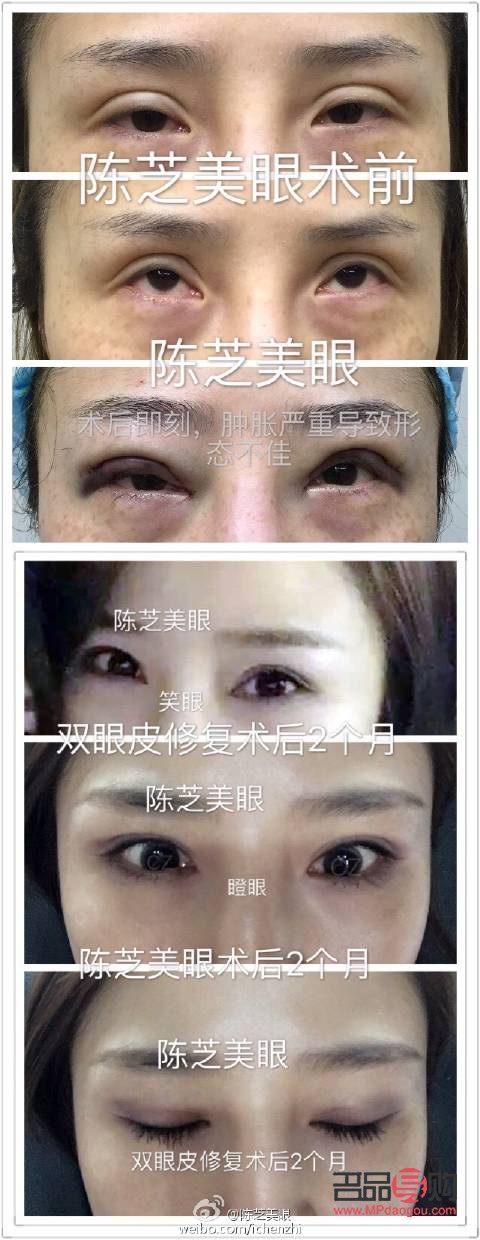 <h3>双眼皮手术对老年时期的影响探究</h3> <h3>双眼皮手术对老年时期的影响探究</h3>