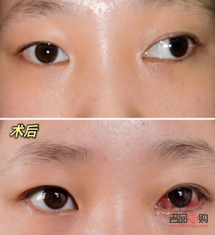 对眼矫正手术多少钱安阳市(对眼矫正的最佳年龄)