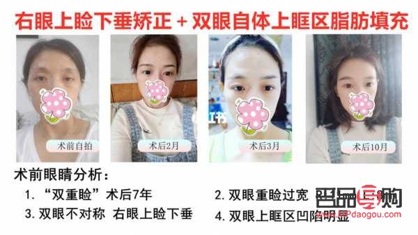 对眼矫正手术多少钱安阳市(对眼矫正的最佳年龄)