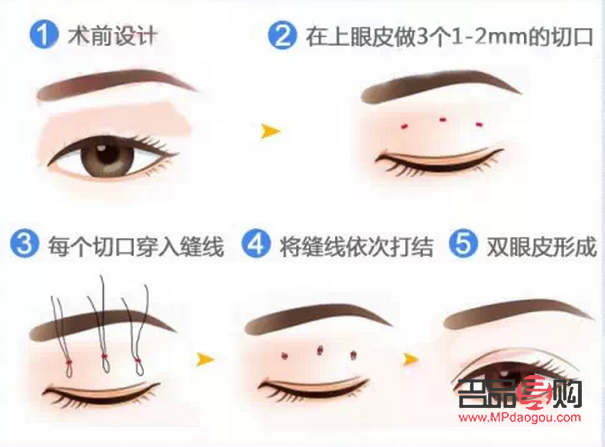 <h3>选择最佳季节割双眼皮，美丽更需安全相伴</h3>