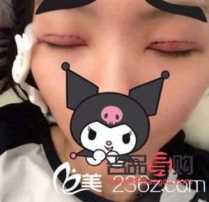 选择最佳季节割双眼皮，美丽更需安全相伴