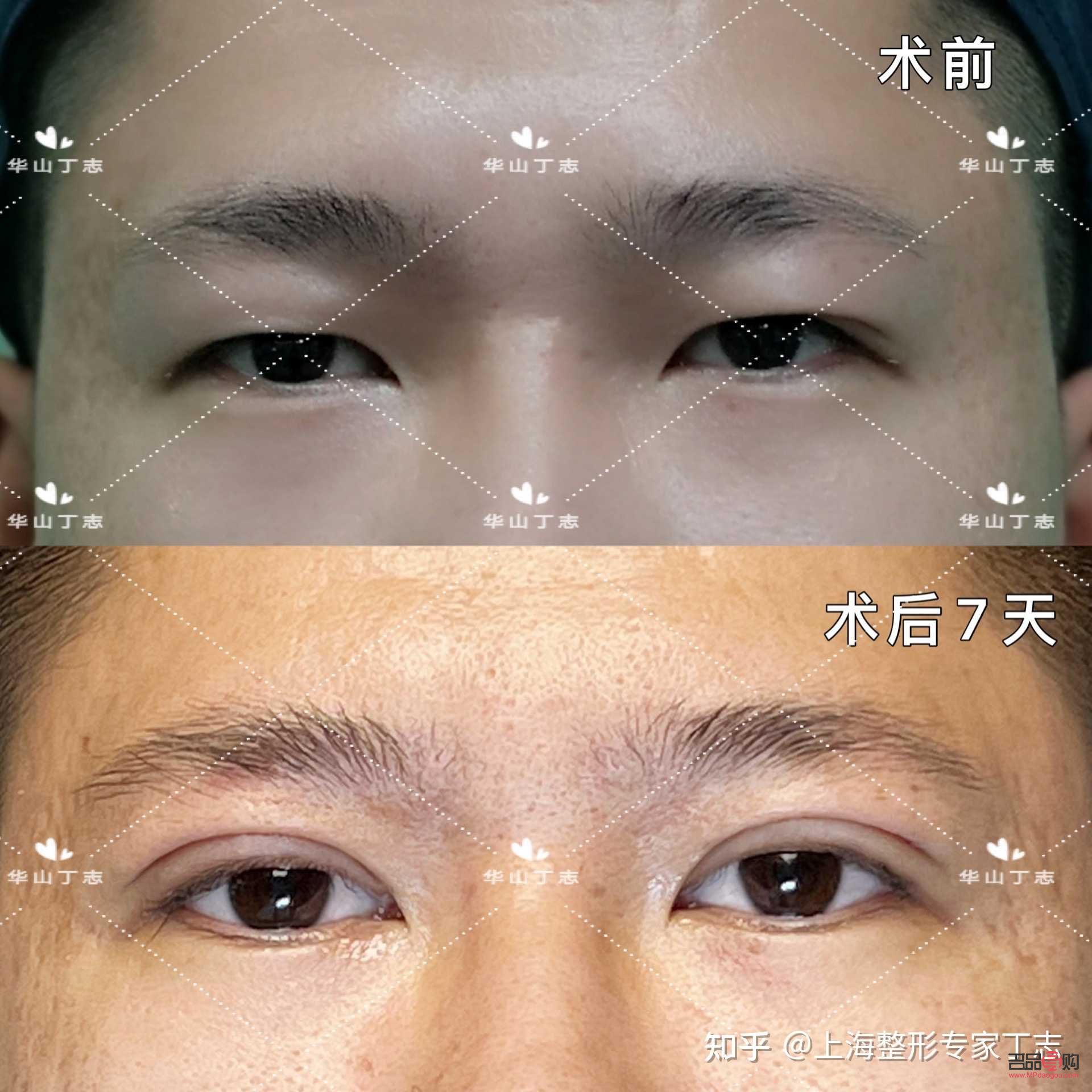 男人肿眼泡需要做什么手术(男人肿眼泡需要做什么手术?) 男人肿眼泡需要做什么手术(男人肿眼泡需要做什么手术?)