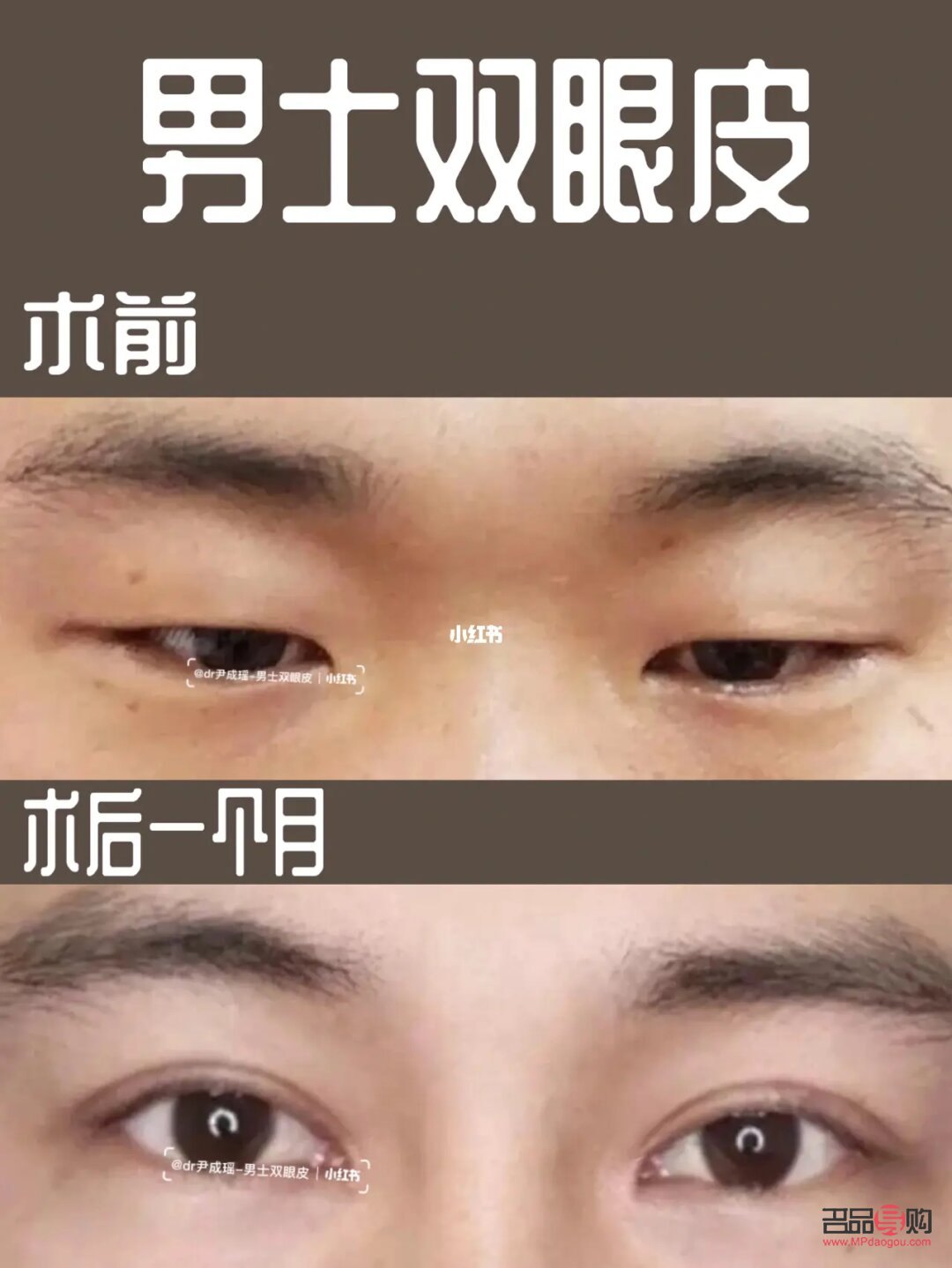 男人肿眼泡需要做什么手术(男人肿眼泡需要做什么手术?)