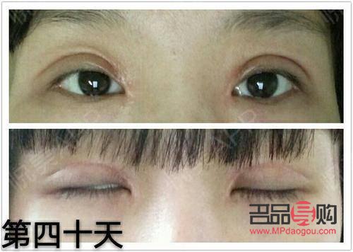 <h3>内双与双眼皮手术：值得考虑的选择？</h3>