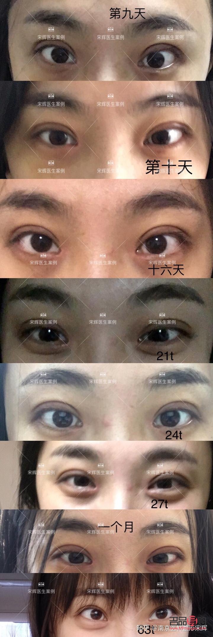 <h3>内双与双眼皮手术：值得考虑的选择？</h3>