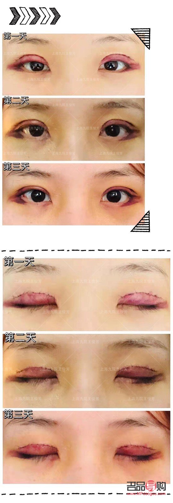 <h3>探寻最佳双眼皮效果：哪款双眼皮手术效果最理想？</h3>