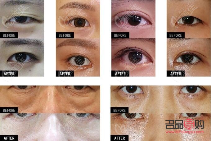 <h3>探寻去眼下皱纹的费用之谜</h3>