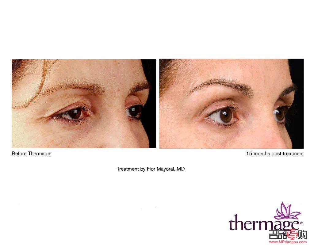 <h3>探寻去眼下皱纹的费用之谜</h3>