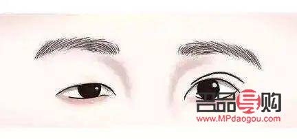 大小眼问题是否可通过双眼皮手术改善？