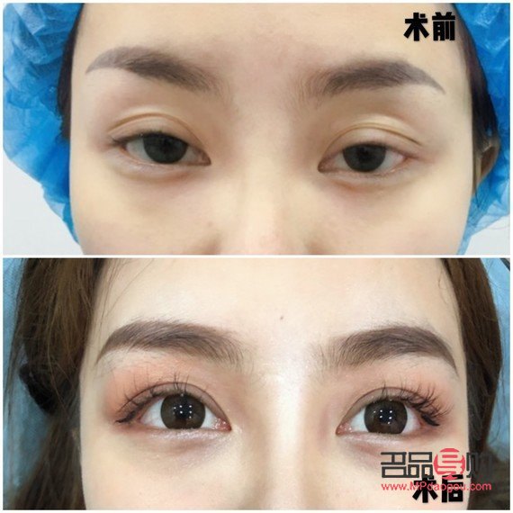 双眼皮的多样眼型图解 双眼皮的多样眼型图解