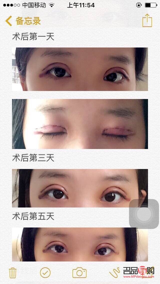 全切双眼皮可以做几次(全切双眼皮可以做几次修复)