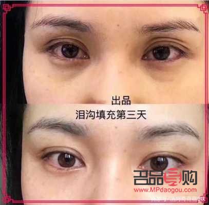 填充眼窝大概多少钱(填充眼窝大概多少钱一次)