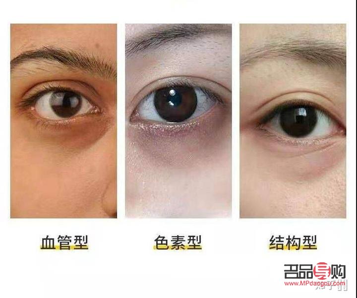 眼部黑色素代谢不出来怎么办(黑眼圈激光一次多少钱)