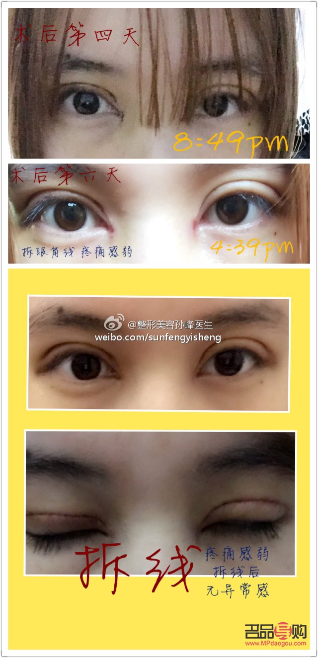 <h3>双眼皮刚拆线效果图解析及术后护理指南</h3> <h3>双眼皮刚拆线效果图解析及术后护理指南</h3>