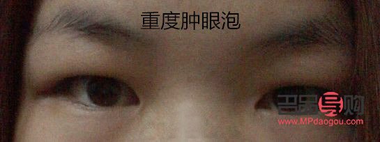 <h3>探究小朋友眼泡肿胀的成因</h3> <h3>探究小朋友眼泡肿胀的成因</h3>