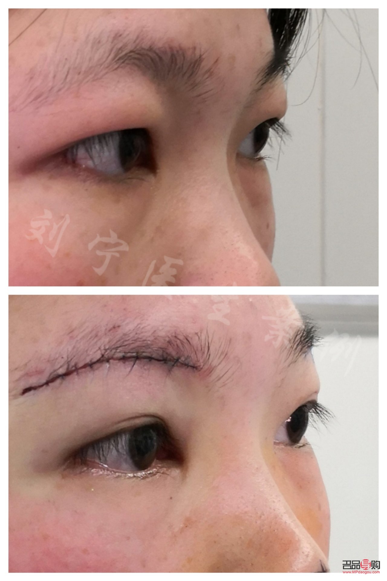 探究小朋友眼泡肿胀的成因