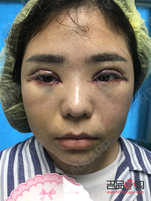 双眼皮手术后，冰敷眼睛的正确方式