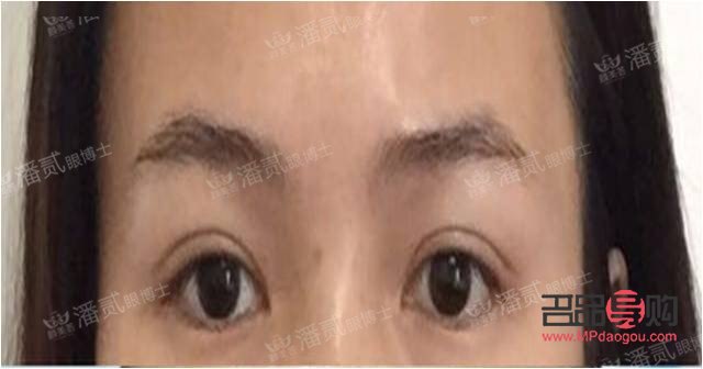 上眼皮长脂肪怎么办(眼皮上长了个脂肪块怎么去除)