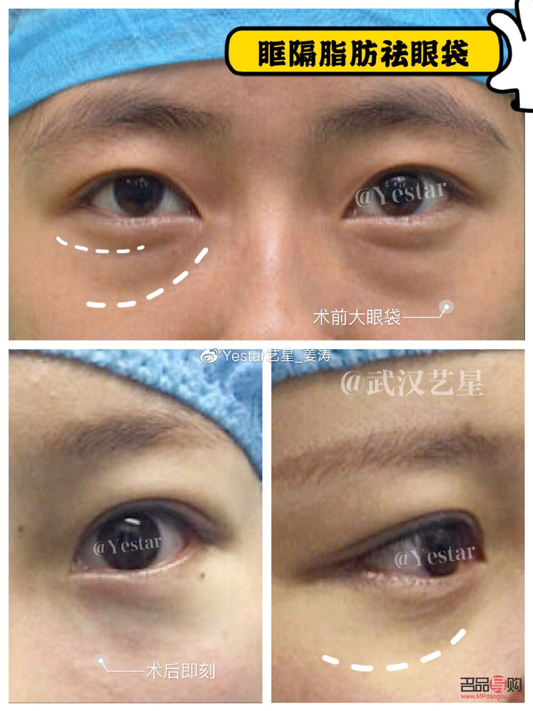 小学生如何去眼袋(小学生如何去眼袋最有效)