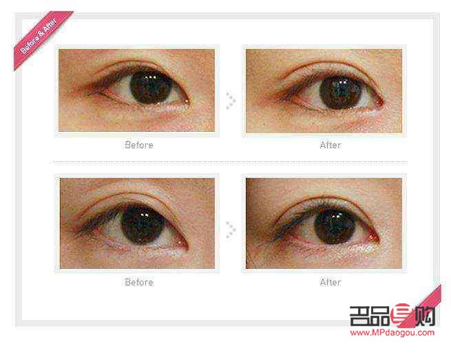 <h3>眼部抽脂手术费用及注意事项</h3>