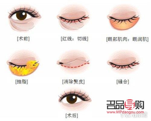 眼部抽脂手术费用及注意事项