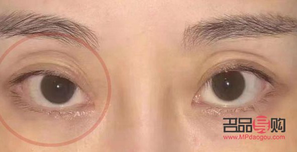 改善眼眶凹陷(改善眼眶凹陷的方法)