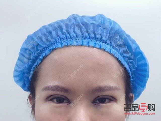 <h3>探索6.5毫米双眼皮的魅力</h3>