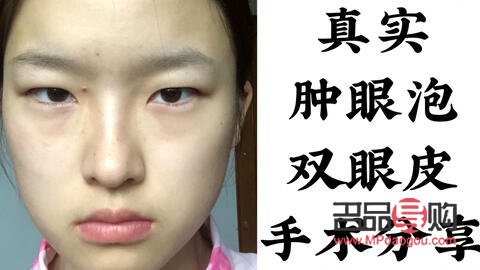 免麻双眼皮的做法(免麻双眼皮是什么技术)