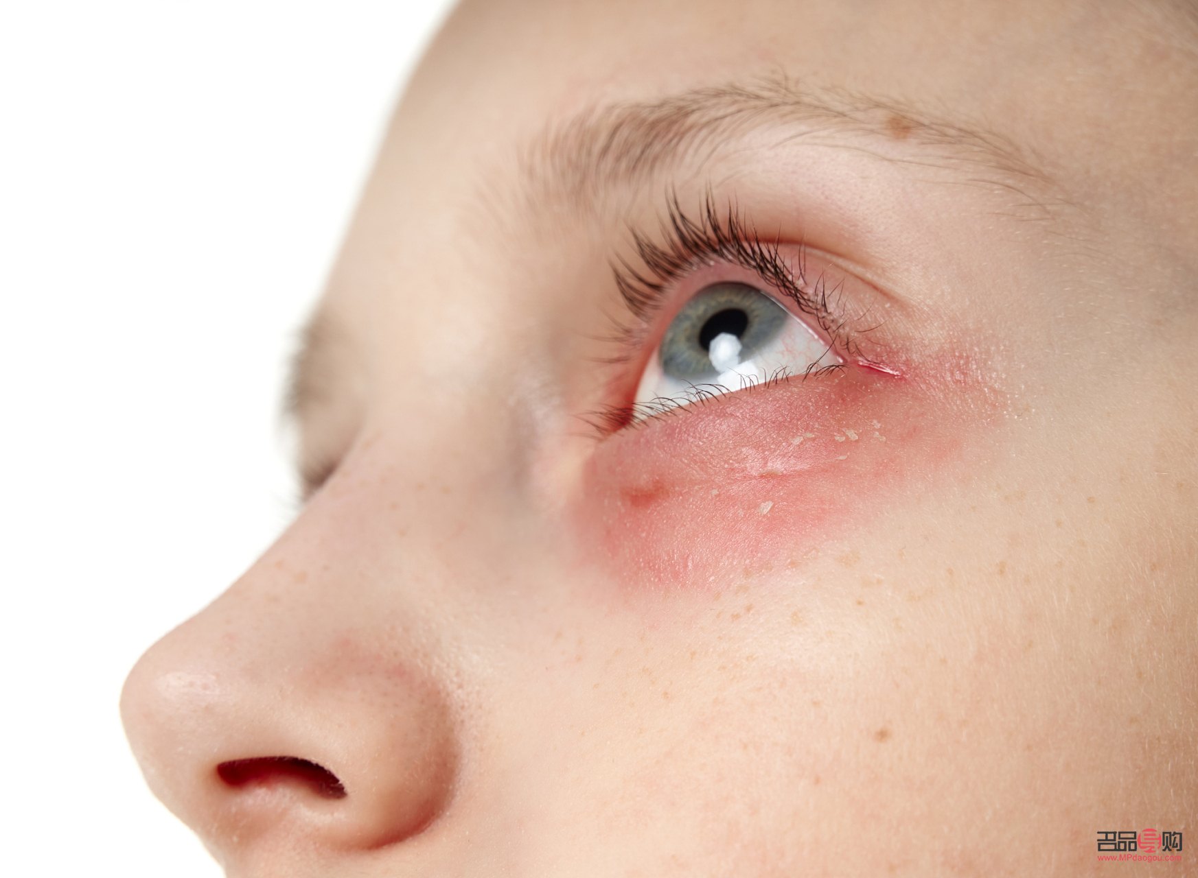 <h3>眼部过敏怎么办？全面解析应对方法与注意事项</h3>