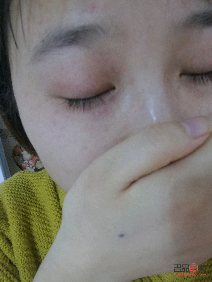 眼部过敏怎么办？全面解析应对方法与注意事项