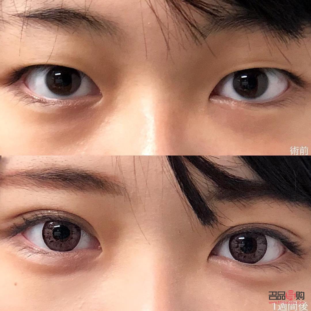 双眼皮的人多还是单眼皮的人多(世界上双眼皮的人多还是单眼皮的人多)