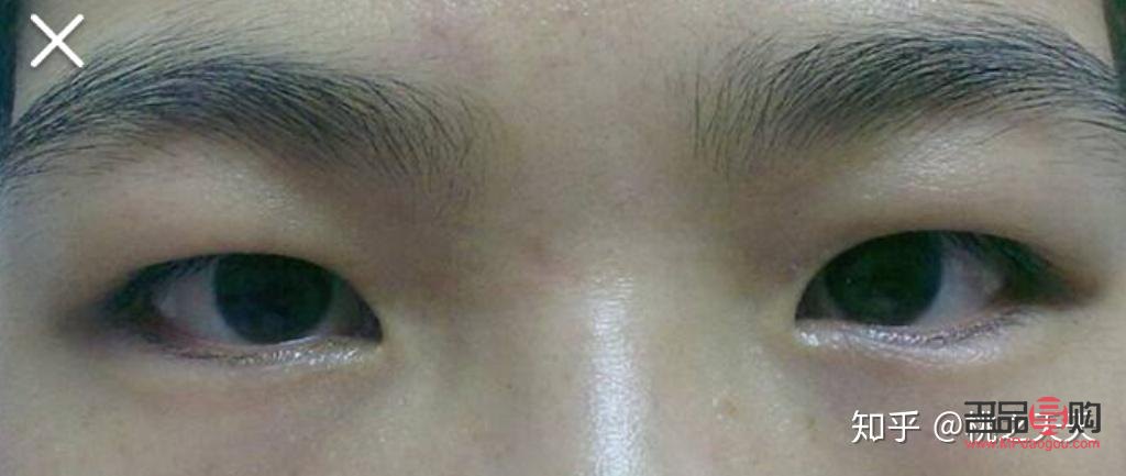 怎么改善天生的肿眼泡(怎么样改变天生肿泡眼)