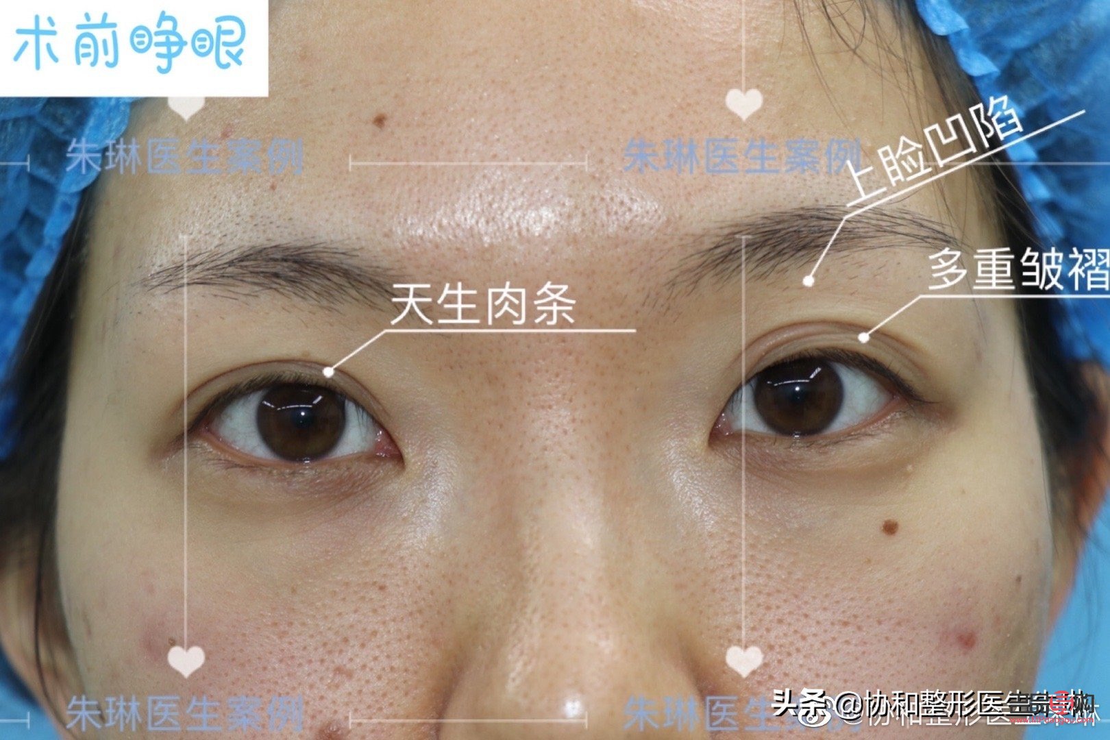 全切双眼皮：美丽与风险并存的选择