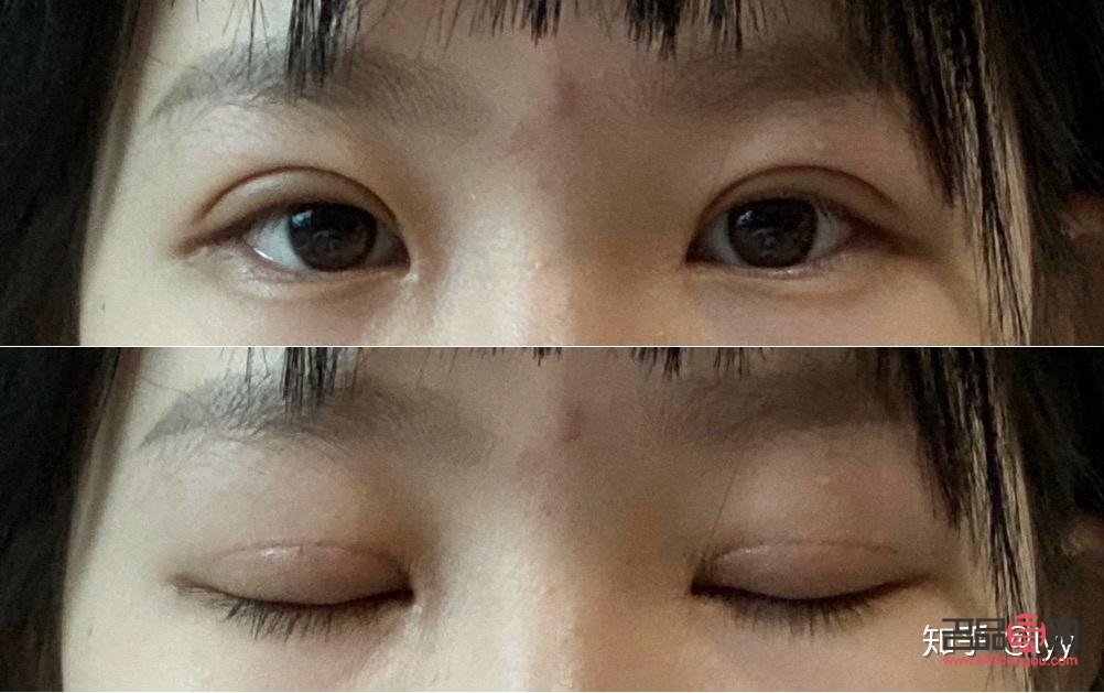 <h3>开扇双眼皮恢复过程全解析</h3>