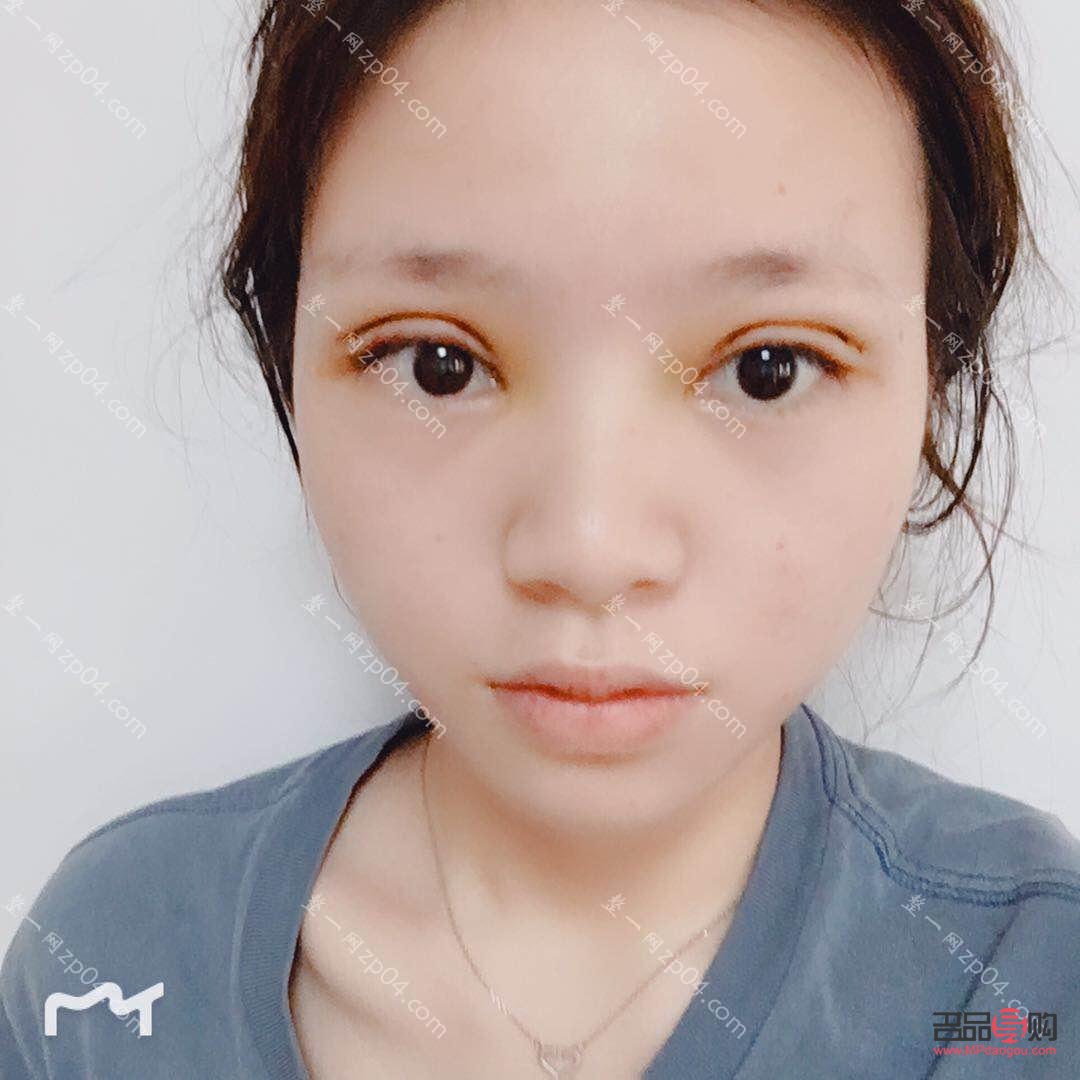 <h3>开扇双眼皮恢复过程全解析</h3>