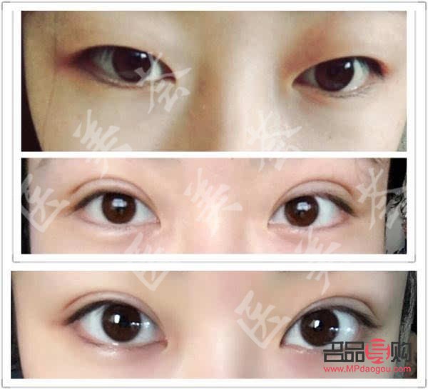 <h3>开扇双眼皮恢复过程全解析</h3>
