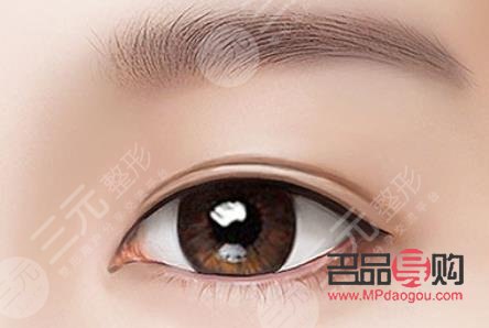 广尾式双眼皮(广尾式双眼皮图片) 广尾式双眼皮(广尾式双眼皮图片)
