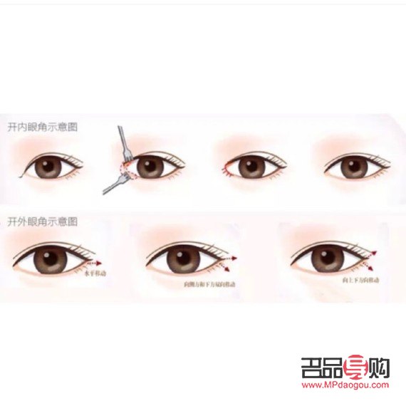 广尾式双眼皮(广尾式双眼皮图片) 广尾式双眼皮(广尾式双眼皮图片)