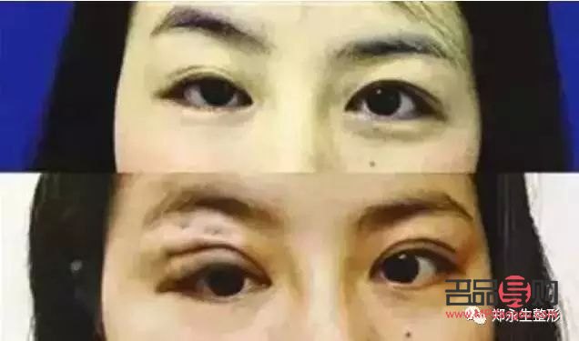 <h3>眼皮一边内双一边外双怎么办？解决双眼皮不对称问题全攻略</h3>