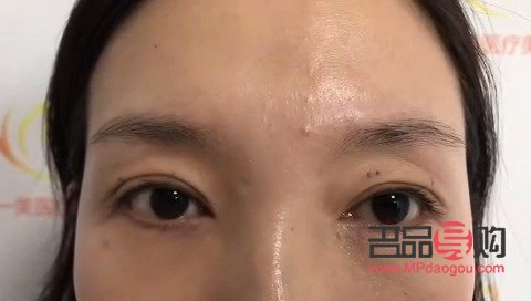 <h3>眼皮一边内双一边外双怎么办？解决双眼皮不对称问题全攻略</h3>