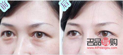 <h3>卧蚕与眼袋：笑容中的微妙差异</h3>