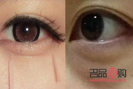 卧蚕与眼袋：笑容中的微妙差异