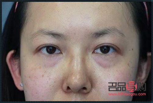 <h3>15岁有眼袋,原因何在?</h3> <h3>15岁有眼袋,原因何在?</h3>