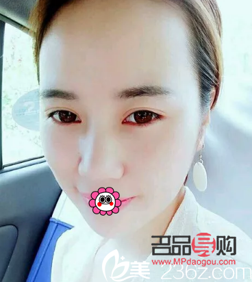 全切双眼皮20天的状态(全切双眼皮20天的状态图片)