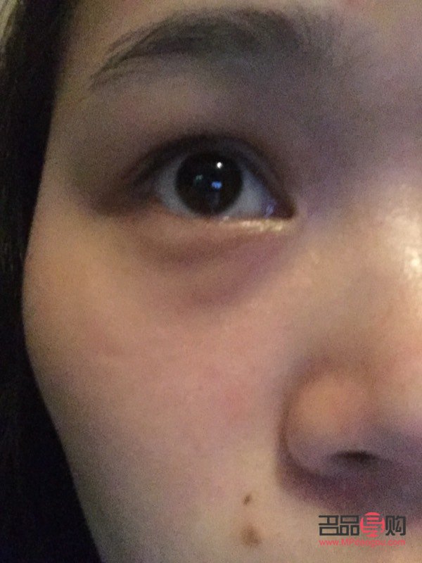 下眼袋处肿了像蚊子包怎么办(下眼袋处肿了像蚊子包怎么办用什么药)