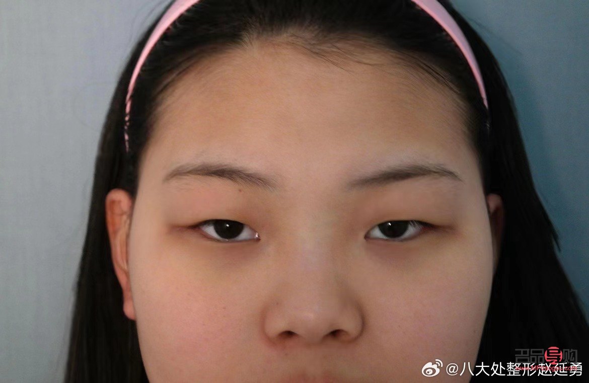 <h3>肿眼泡手术后是否会再次复发?</h3> <h3>肿眼泡手术后是否会再次复发?</h3>