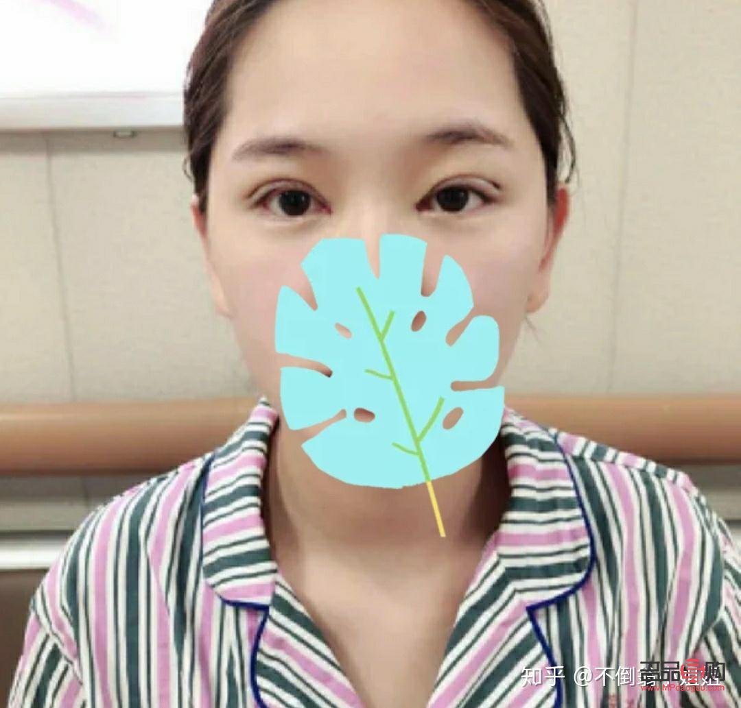 <h3>肿眼泡手术后是否会再次复发?</h3> <h3>肿眼泡手术后是否会再次复发?</h3>