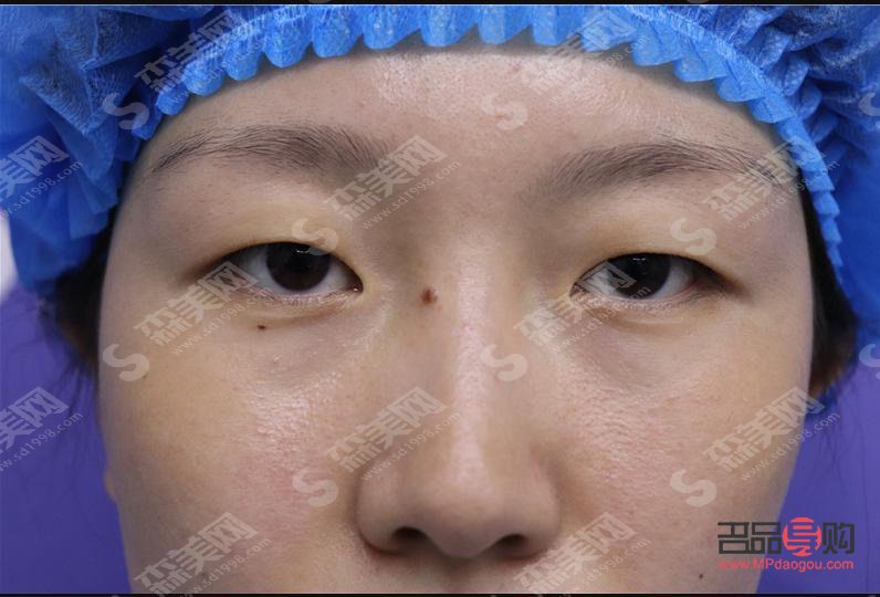 肿眼泡手术后是否会再次复发？