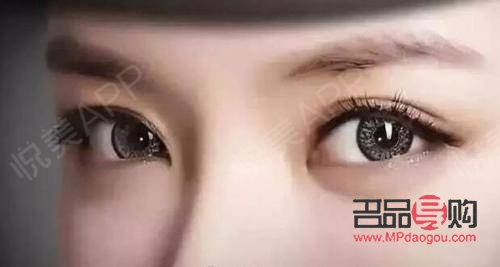 双眼皮美学：探索最受欢迎的双眼皮款式